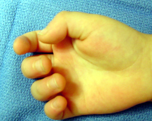 Trigger finger in children most likely involves the thumb