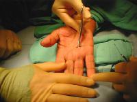 Trigger finger treatment Trigger finger release allows tendon to move freely