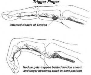 Trigger-finger-pain.jpg