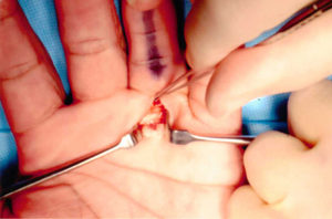 trigger-finger-surgery.jpg